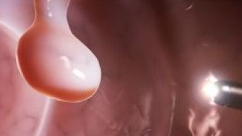 Importanța depistării precoce a cancerului colorectal: un ghid esențial pentru prevenție și tratament