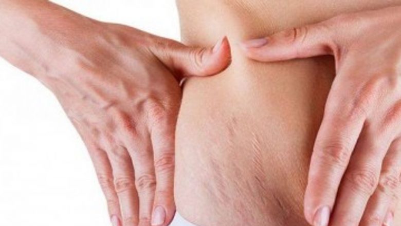 Ghid complet pentru estomparea vergeturilor post-naștere: metode, alimente și exerciții eficiente
