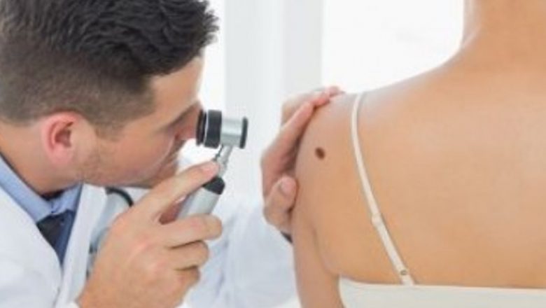 Alunițele: Cum să Le Monitorizăm și Să Ne Protejăm de Riscurile Cancerului de Piele