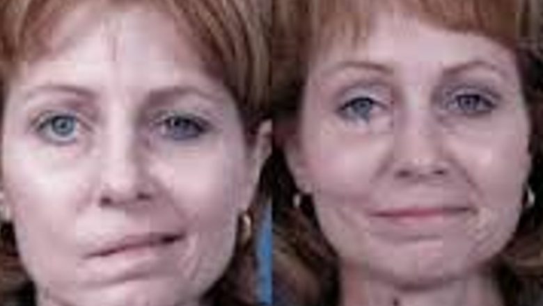 Asimetria facială: un semnal de alarmă pentru atacurile cerebrale