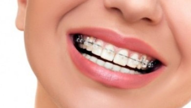 Ghid complet asupra aparatelor dentare pentru adulți: Opțiuni, avantaje și implicații pe termen lung