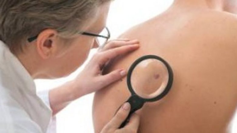 Simptome Ascunse ale Cancerului de Piele: Ce Trebuie Să Știm pentru a Ne Proteja Sănătatea