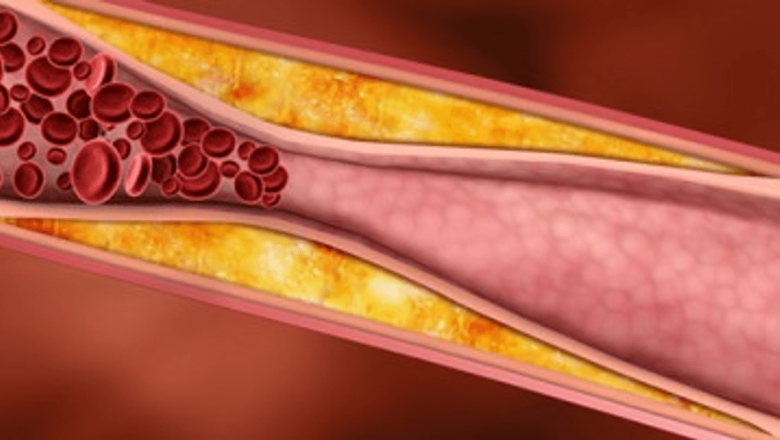 Complicațiile arterelor înfundate: Impactul aterosclerozei asupra sănătății cardiovasculare și nu numai