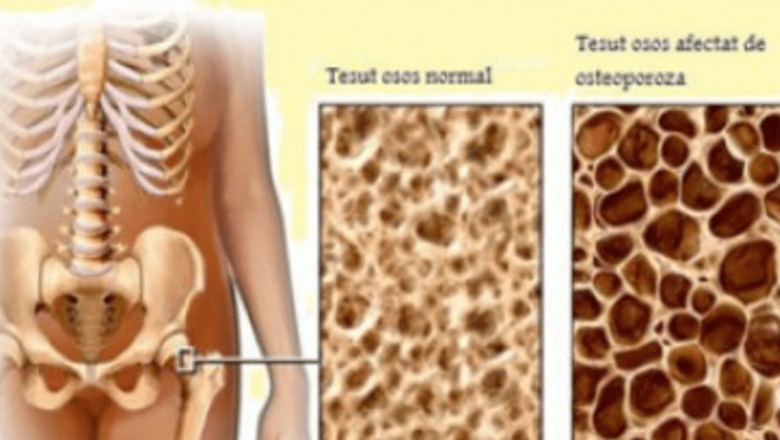 Osteoporoza: O privire detaliată asupra bolii oaselor fragile și implicațiile sale