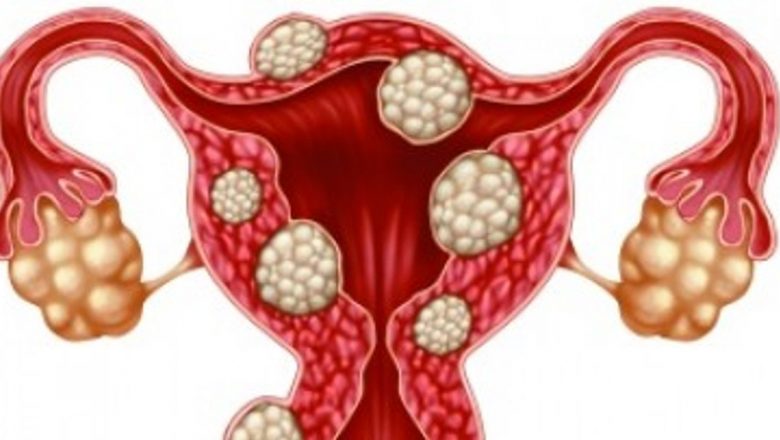 Fibromul uterin: Înțelegerea complexității, simptomelor și opțiunilor de tratament