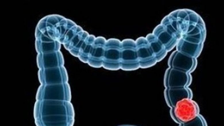 Importanța Testelor Gratuite pentru Depistarea Cancerului Colorectal: O Inițiativă Necesara în România