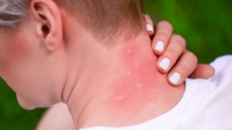 Remedii Naturale Eficiente pentru Întreținerea Pielii după Înțepăturile de Insecte