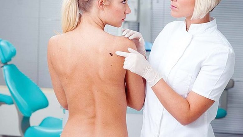 Microchirurgia Mohs: O Revoluție în Tratamentul Cancerului de Piele cu Risc Minim de Recidivă