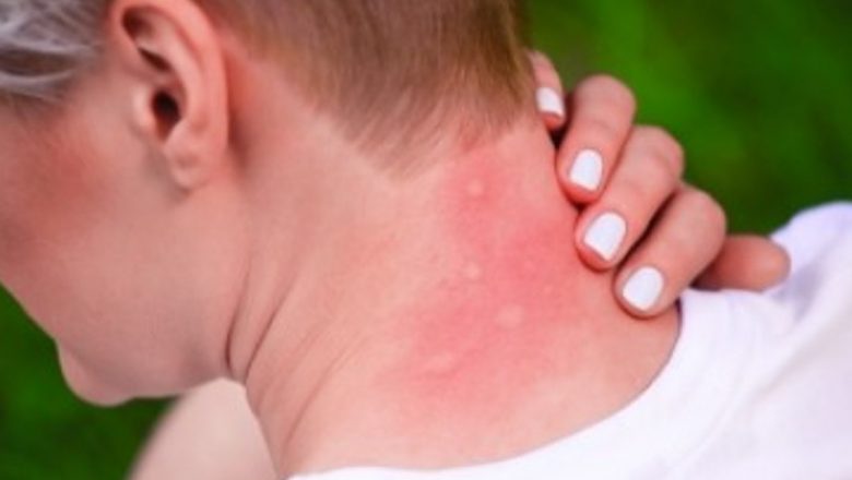 Remedii Naturale Eficiente pentru Înțepăturile de Insecte: Ghid Complet
