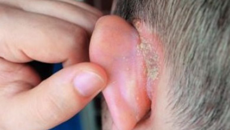 Remedii Naturale Eficiente pentru Psoriazis: O Abordare Holistică