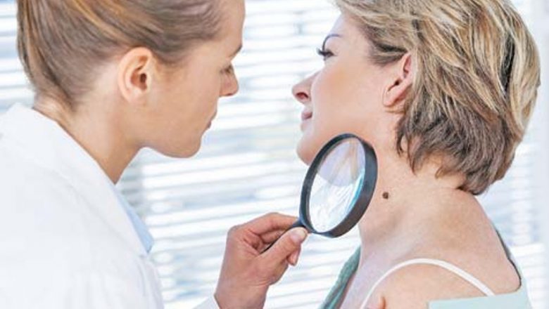 Importanța inspecției alunițelor la final de vară: prevenirea cancerului de piele