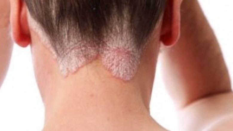 Psoriazisul: O Privire Asupra Stigmatizării și Impactului Asupra Vieții Pacienților