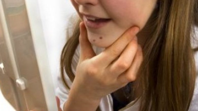 Acneea: O Problemă Globală Indiferent de Vârstă și Cum Să O Combatem Eficient
