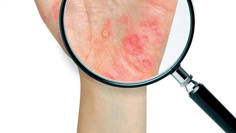 Psoriazisul: O privire detaliată asupra unei afecțiuni cutanate neînțelese și stigmatizate