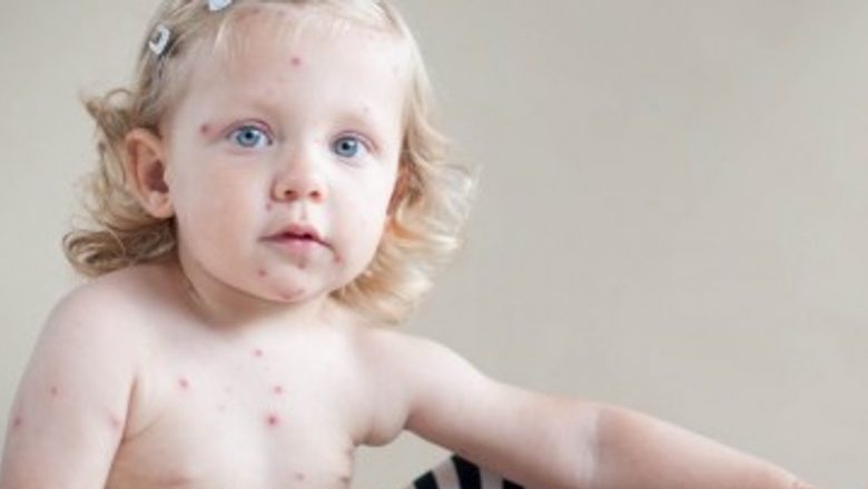 Importanța unei diete sănătoase în timpul varicelei: Ghid complet pentru părinți