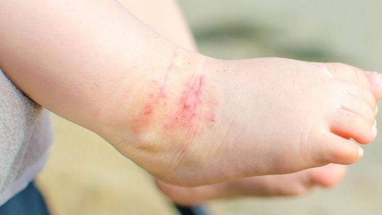 Impactul curățeniei excesive asupra dermatitei atopice: O analiză detaliată