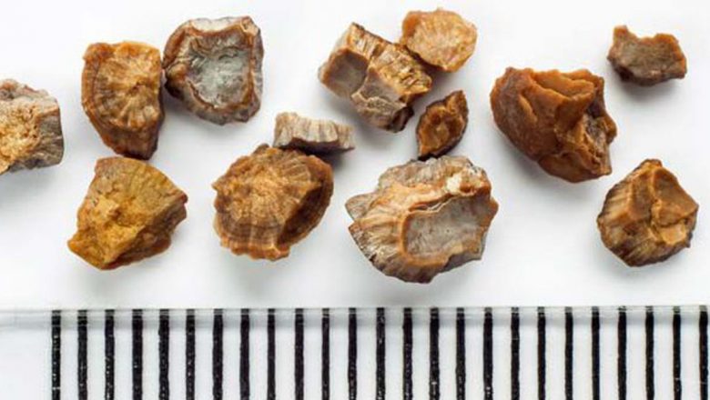 Remedii Naturale: Ceaiuri Eficiente Contra Pietrelor la Fiere