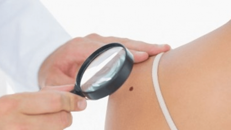 Importanța verificării anuale a alunițelor: O măsură vitală pentru prevenirea cancerului de piele