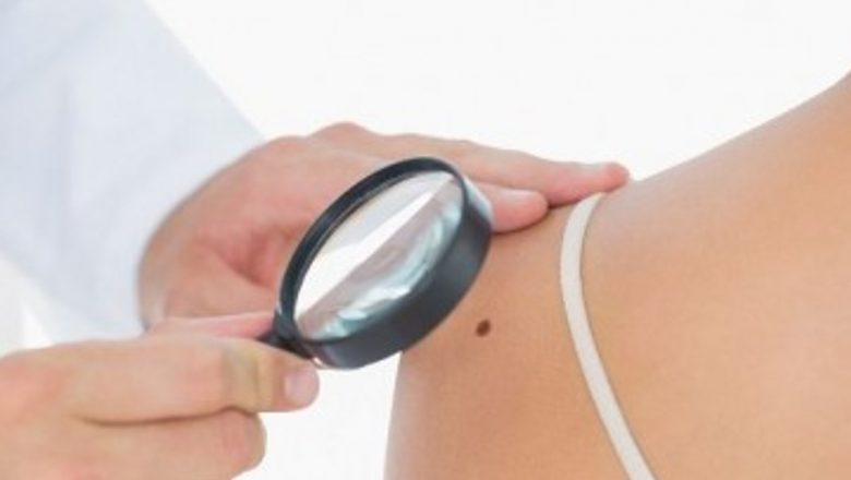 Importanța verificării anuale a alunițelor: o măsură esențială în prevenția cancerului de piele