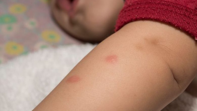 Cum să identifici mușcăturile de insecte: Ghid complet pentru sănătatea ta