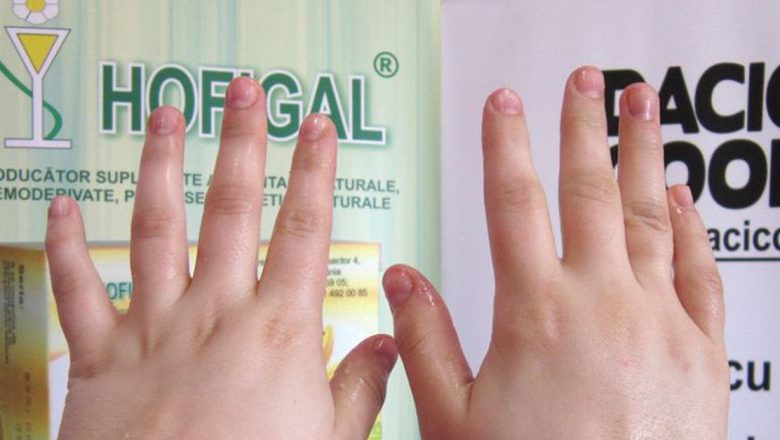 Mâini umflate dimineaţa: Cauze, remedii şi implicaţii asupra sănătăţii