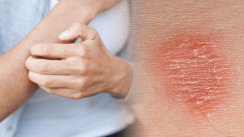 Alergia cutanată: Cauze, simptome, tratamente și măsuri de prevenire