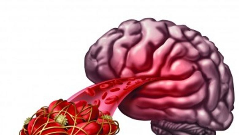 Pericolele Cheagurilor de Sânge: Înțelegerea Trombozei și Impactul Asupra Sănătății