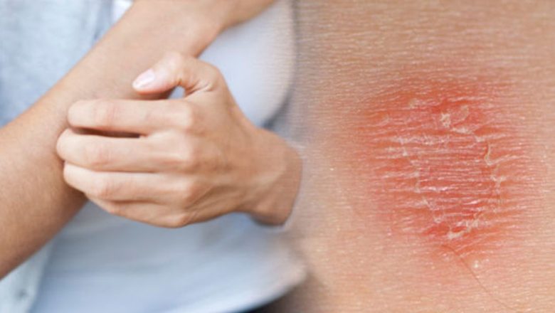 Alergia cutanată: Înțelegerea, tratamentul și prevenția acestei afecțiuni neplăcute