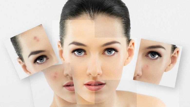 Abordarea Dietetică în Combaterea Acneei: Ce Alimente Pot Face Diferența?