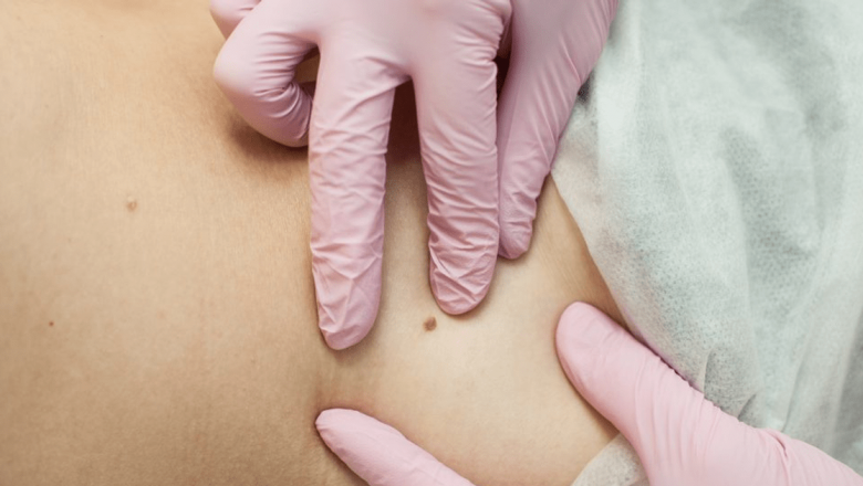 Papiloamele: Înțelegerea excrescențelor cutanate și opțiunile de tratament