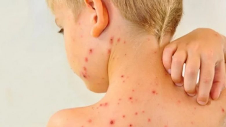 Epidemia de rujeolă în România: O criză sanitară care necesită atenție urgentă