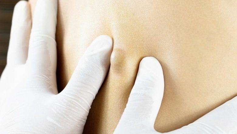 Furunculul: Simptome, Cauze și Tratament – Ghid Complet pentru Înțelegerea Această Afecțiune Comună