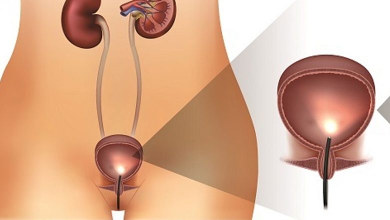 Cistoscopia: O Investigație Esențială pentru Sănătatea Vezicii Urinare
