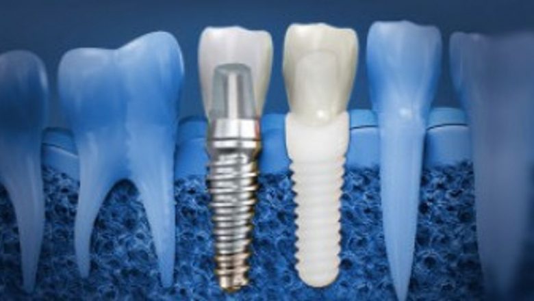 Revoluția Implantologiei în România: Un Masterplan Digital pentru Sănătatea Dentară