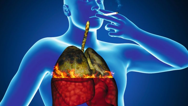 Cancerul Pulmonar: O Privire Aprofundată Asupra Factorilor de Risc, Diagnosticării și Tratamentului