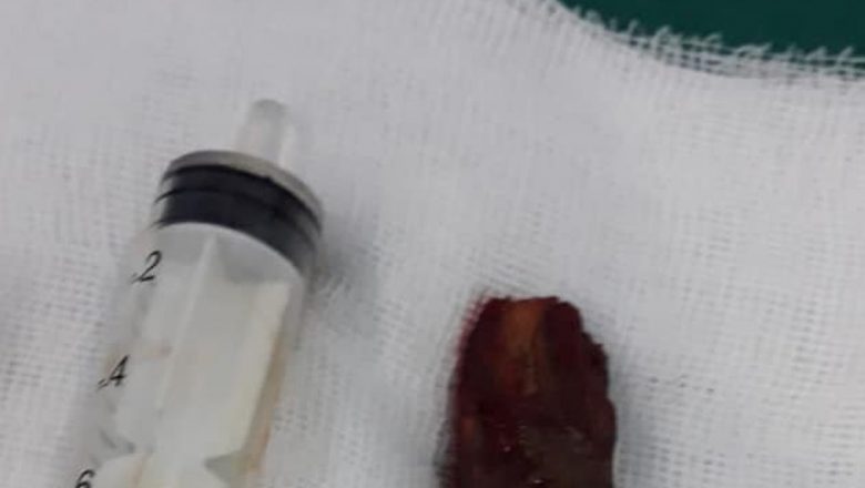 Un caz medical rar: Corp străin în maxilarul unui pacient din București