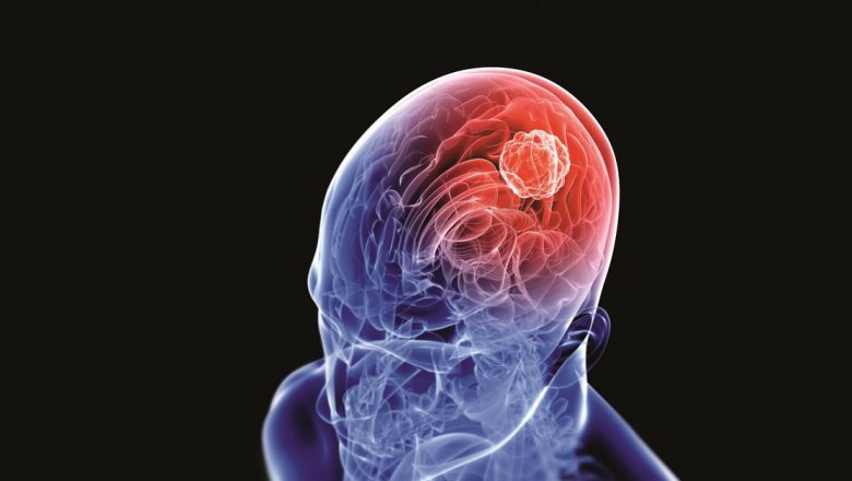 Cancerul cerebral: Simptome, cauze și perspective de tratament