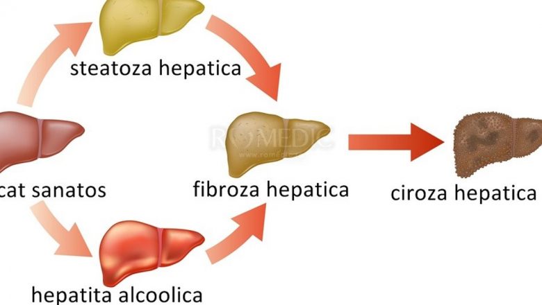 Alexandru Darie: O luptă cu ciroza hepatică și impactul acestei boli asupra vieții și carierei sale