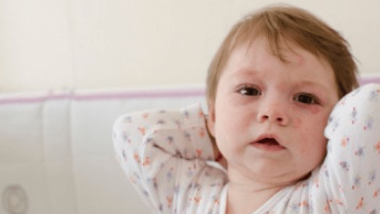 Rujeola: Simptome, Complicații și Importanța Vaccinării în Combaterea Boală