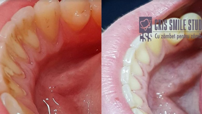 Impactul Tartrului asupra Sănătății Dentare: O Problemă Ignorată