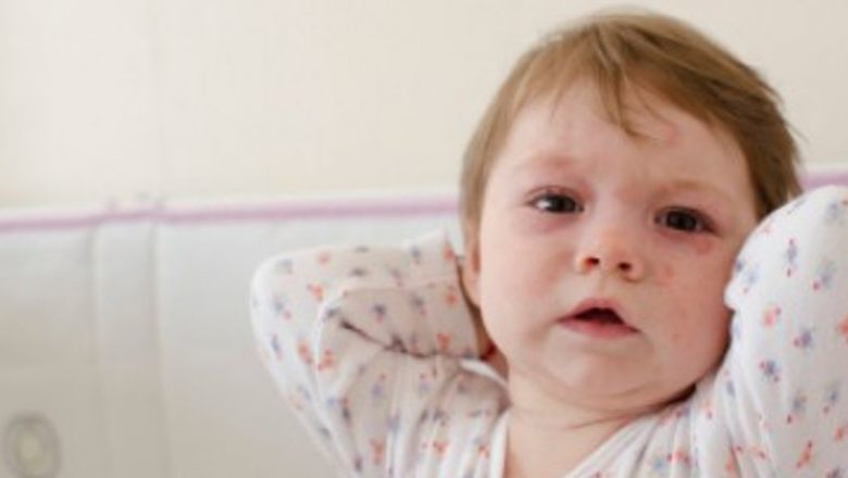 Rujeola: O Analiză Detaliată a Simptomelor, Complicațiilor și Importanței Vaccinării