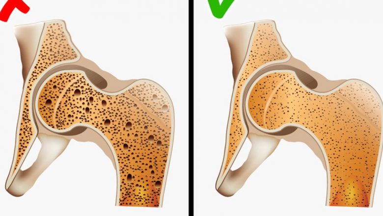 Strategii Eficiente pentru Prevenirea Osteoporozei: O Abordare Holistică