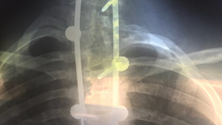 Scolioza: Înțelegerea simptomelor, factorilor de risc și implicațiilor pe termen lung