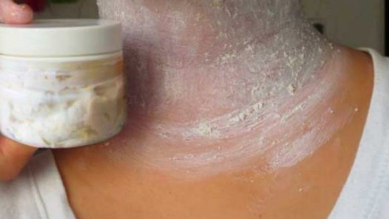 Descoperă soluții eficiente pentru a elimina petele maro de pe piele: metode naturale și sfaturi practice