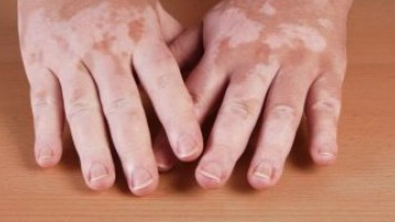Vitiligo: Cauze, Îngrijire și Impactul Asupra Vieții Cotidiene