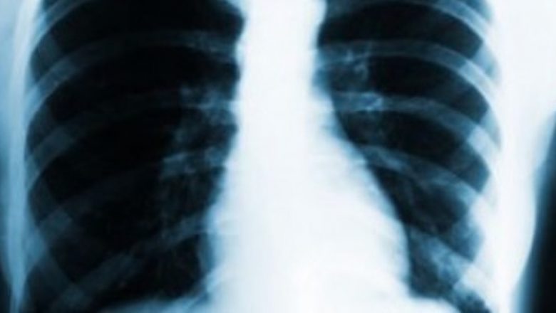 Testul online care poate salva vieți: Evaluarea riscului de cancer pulmonar în România
