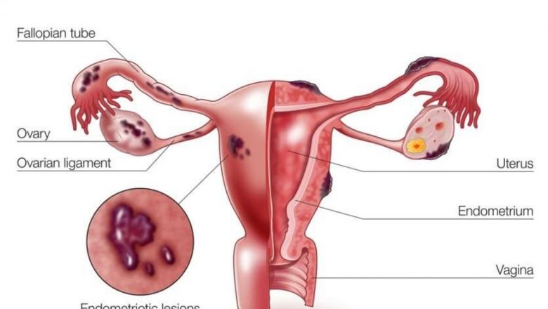 Endometrioza: O Afecțiune Neglijată care Afectează Viața Femeilor
