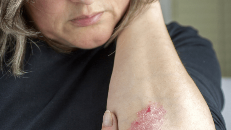 Remedii Naturale pentru Psoriazis: Cum Pot Ajuta Plantele în Gestionarea Această Afecțiune Autoimună