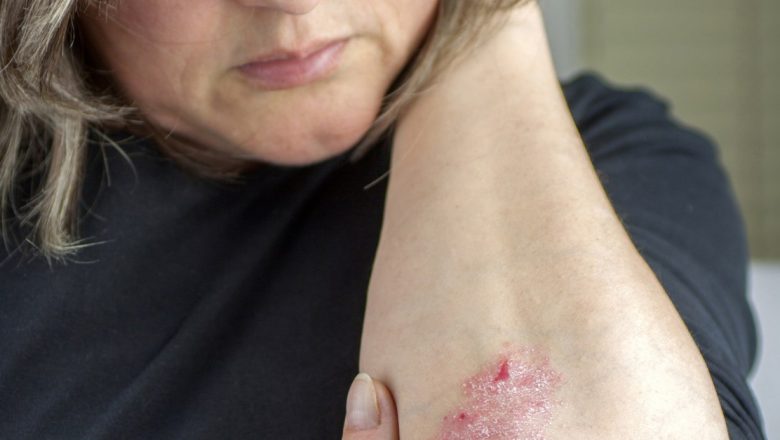Remedii Naturale pentru Psoriazis: Plantele ca Soluție pentru o Afecțiune Autoimună