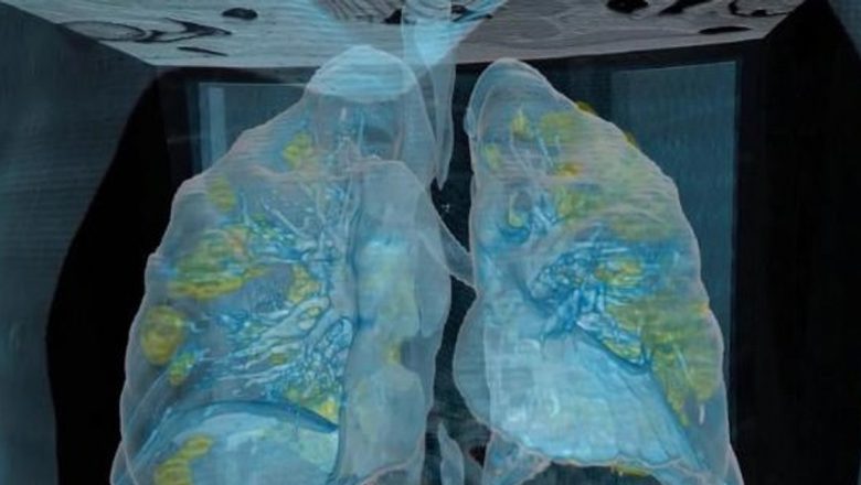 Impactul devastator al COVID-19 asupra plămânilor: Analiză detaliată a unei infecții severe